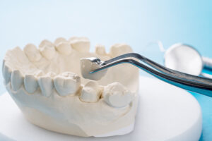 Mansfield, TX, dentist offers dental crowns 