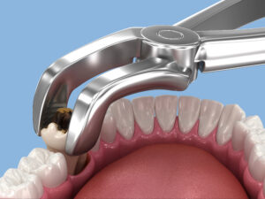 mansfield tooth extraction