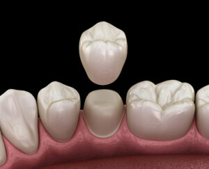 mansfield dental crowns